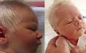 beba-albinizam